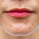 Hormonal Acne