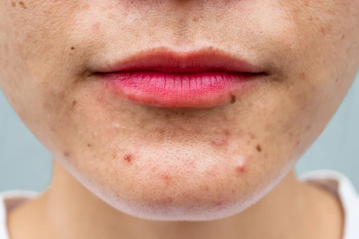 Hormonal Acne